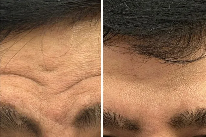 Anti Ageing Result
